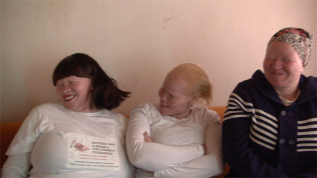 Albinism in South Africa