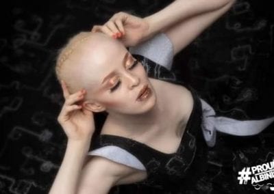 Proud Albinism